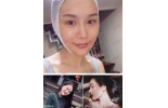 做完线雕后，看看他们是怎么说的